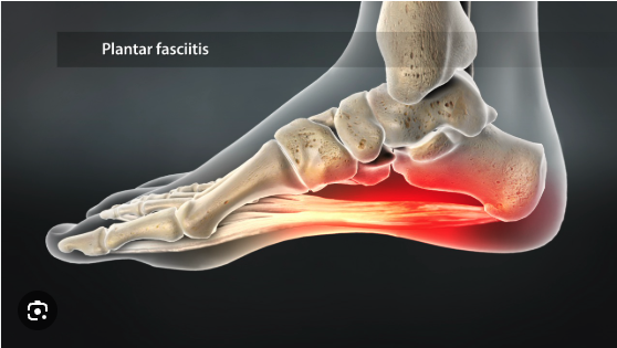 plantaar fascia image